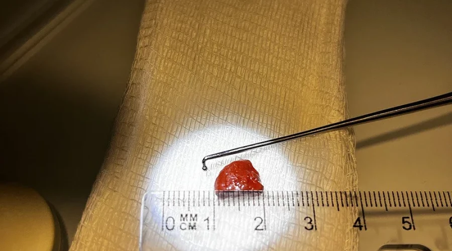 В Ромашково врачи помогли 3-летней девочке, которая засунула в нос камень из аквариума