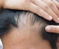 В Сеченовском университете применили новые методы лечения алопеции