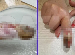 В Одинцово пациентка частной клиники обвинила врача в ошибке, из-за которой лишилась фаланги пальца