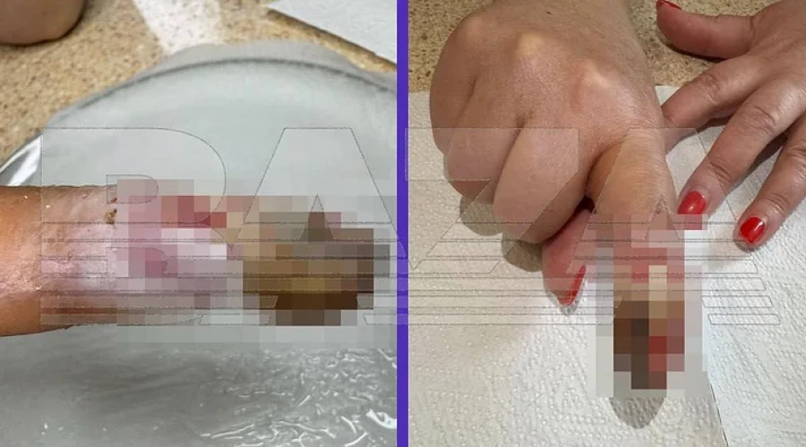 В Одинцово пациентка частной клиники обвинила врача в ошибке, из-за которой лишилась фаланги пальца