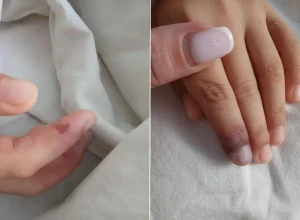 Саратовские врачи спасли девочку с редким аутоиммунным заболеванием